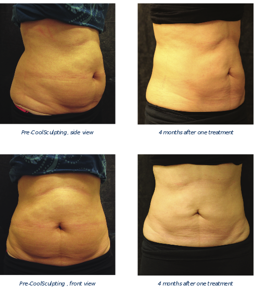 CoolSculpting before and after results from real patients