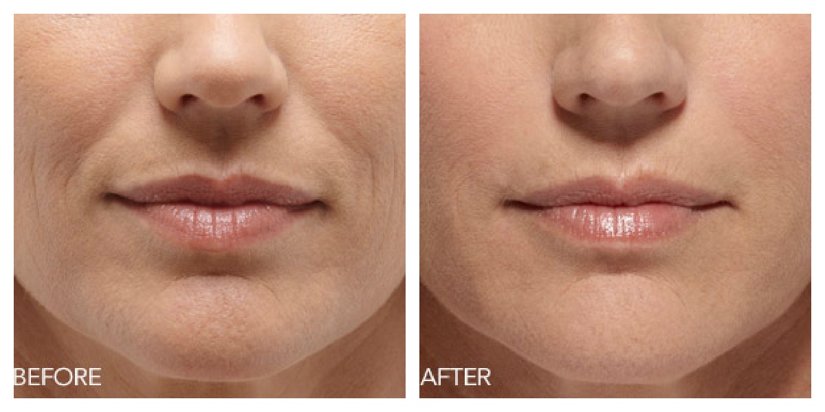 Belotero Before And After Lips