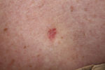 Basal Cell Carcinoma: Appearance and Treatment | Dermatology Consultants