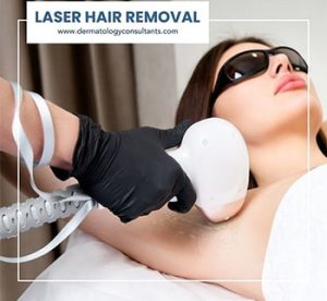 laser removal