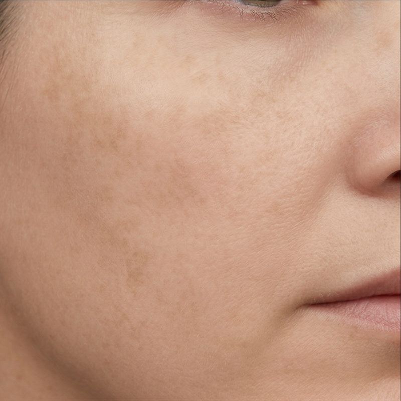 sun pigment management after